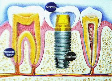 implant3